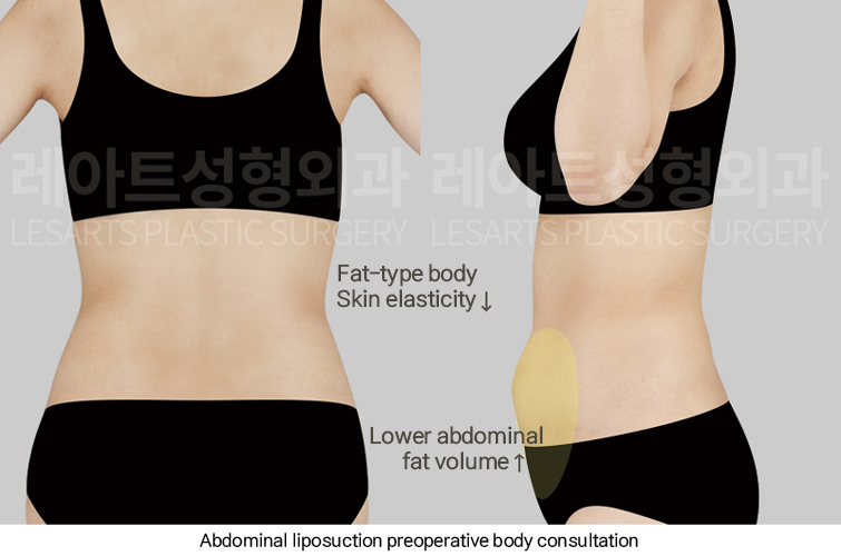 abdominal_liposuction_02_02_250313