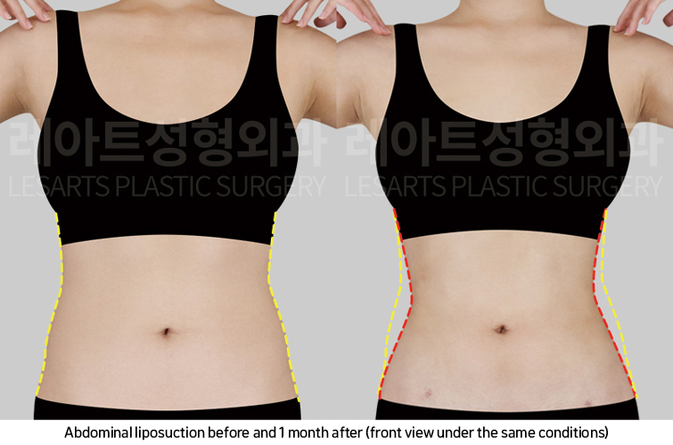 abdominal_liposuction_02_03_250221