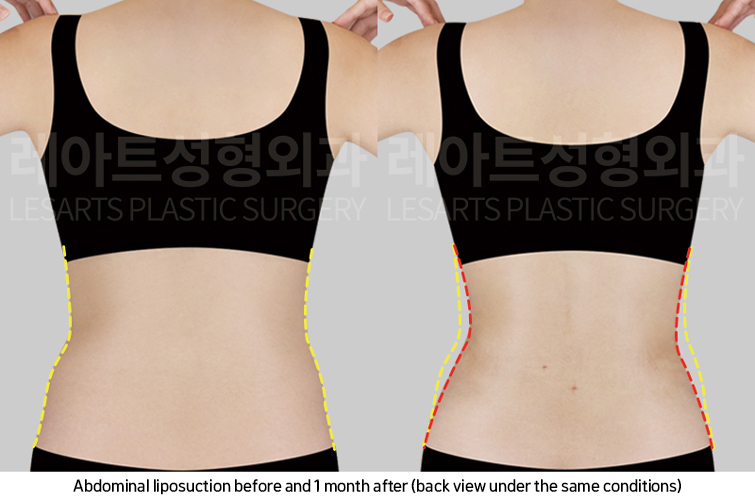 abdominal_liposuction_02_04_250221