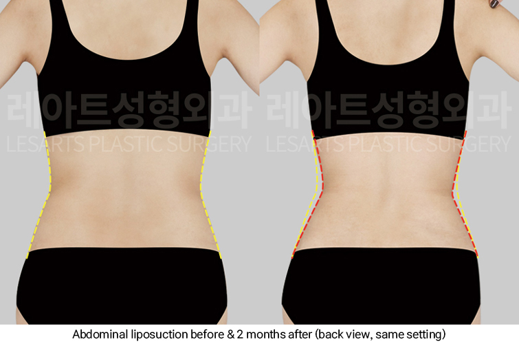 abdominal_liposuction_02_04_250313