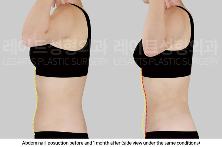 abdominal_liposuction_02_05_250221