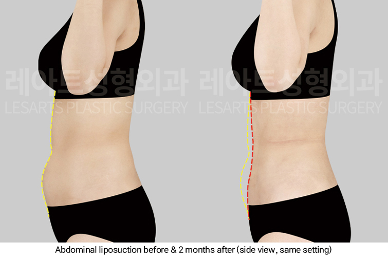 abdominal_liposuction_02_05_250313