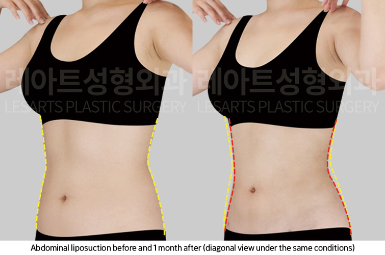 abdominal_liposuction_02_06_250221