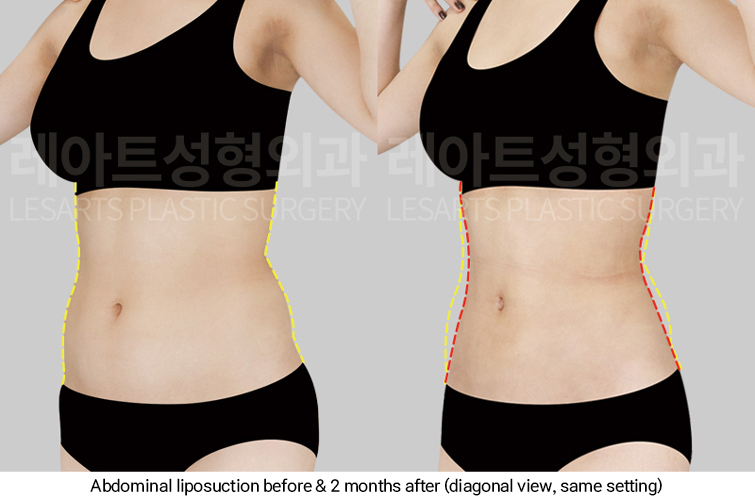 abdominal_liposuction_02_06_250313