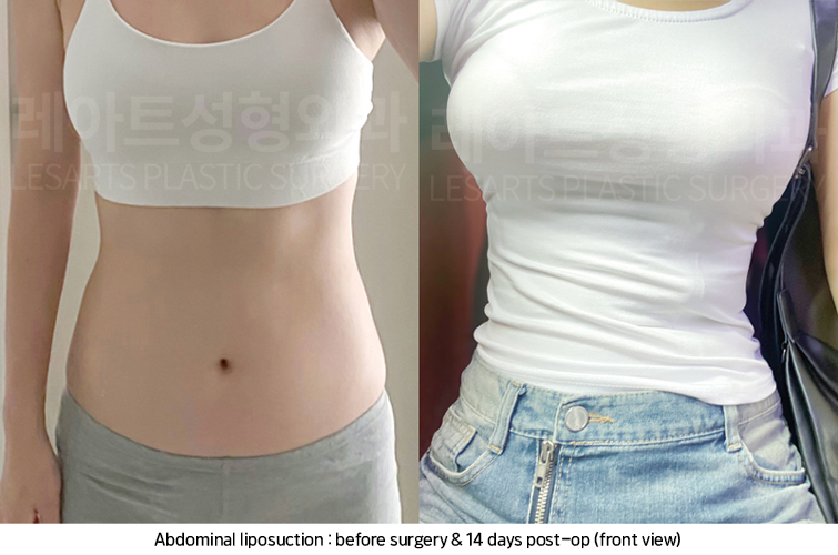 abdominal_liposuction_02_07_250221