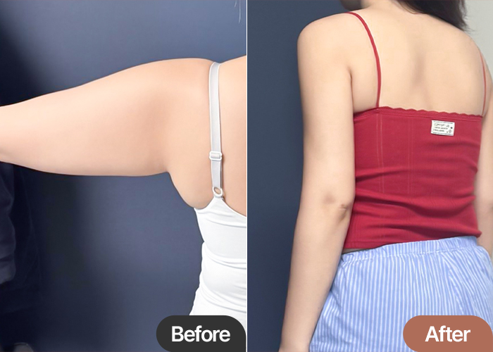 Before and after comparison of arm liposuction at Lesarts in Korea (back view)