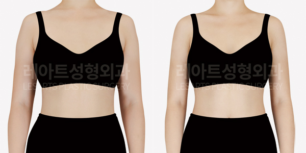 arm_liposuction_01_thumbnail_250219
