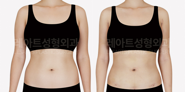 arm_liposuction_01_thumbnail_250311