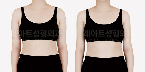 arm_liposuction_01_thumbnail_250319