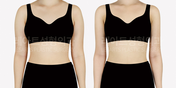 arm_liposuction_01_thumbnail_250327