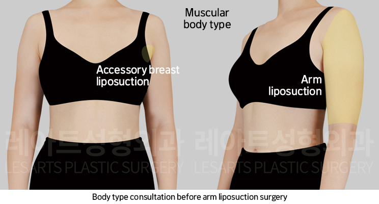 arm_liposuction_02_01_250219
