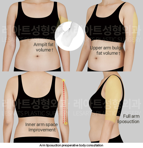 arm_liposuction_02_01_250311