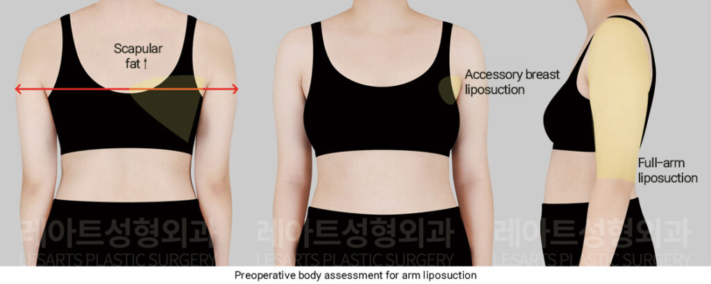 arm_liposuction_02_01_250319