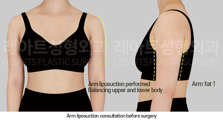 arm_liposuction_02_01_250320