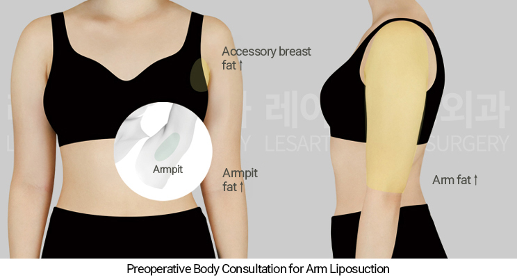 arm_liposuction_02_01_250327
