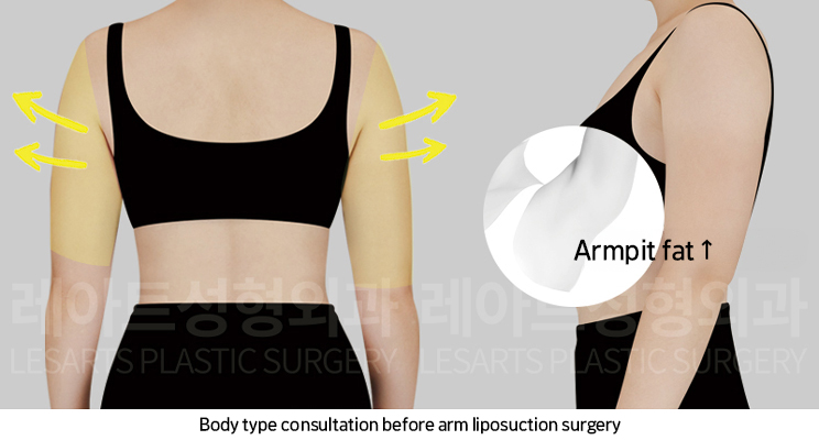 arm_liposuction_02_02_250219
