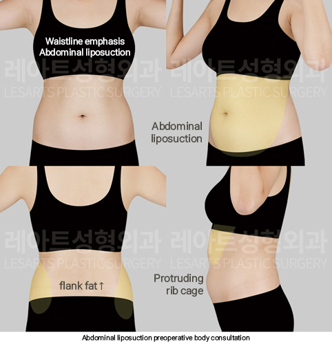 arm_liposuction_02_02_250311