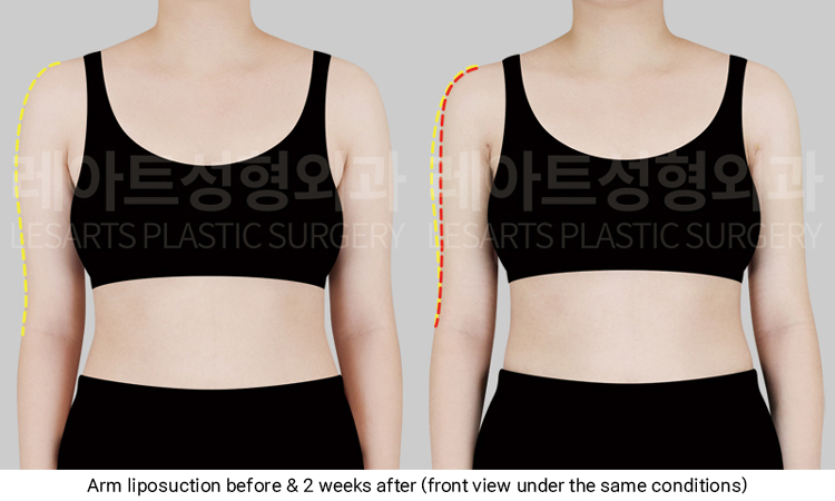 arm_liposuction_02_02_250319