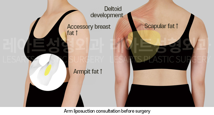 arm_liposuction_02_02_250320