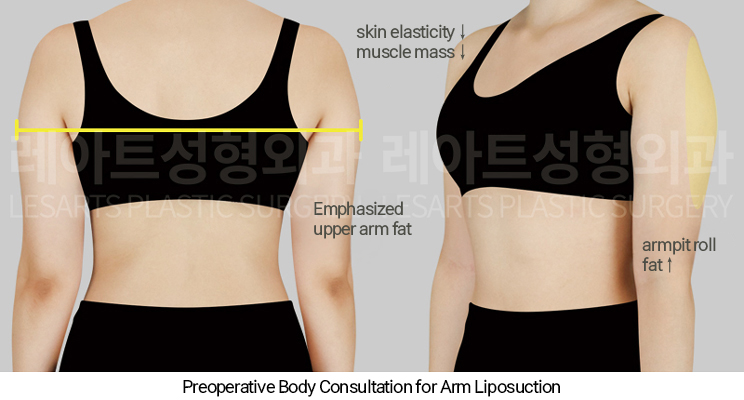 arm_liposuction_02_02_250327