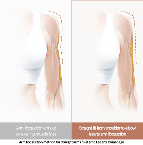 arm_liposuction_02_03_250219