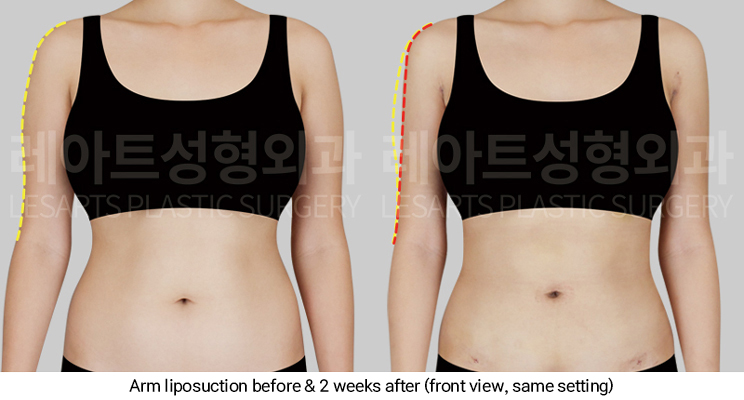 arm_liposuction_02_03_250311
