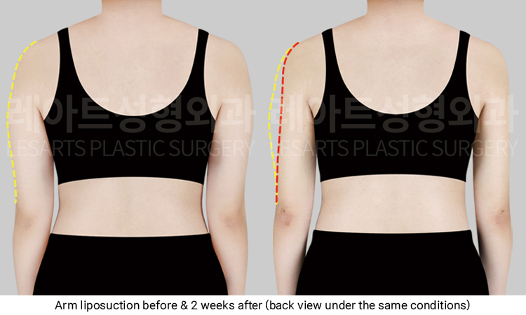 arm_liposuction_02_03_250319