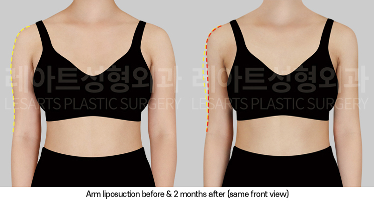 arm_liposuction_02_03_250320