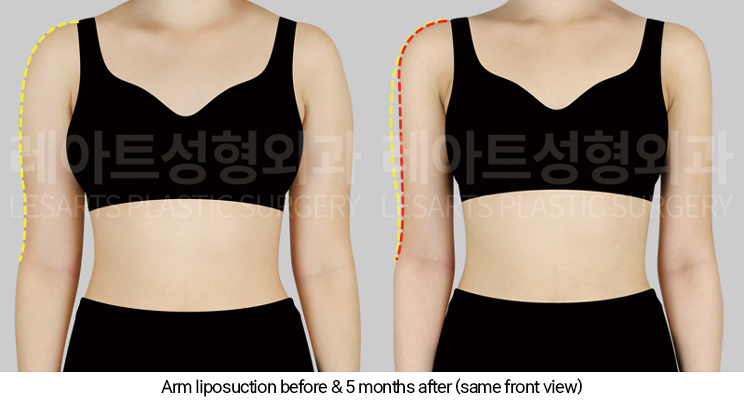 arm_liposuction_02_03_250327