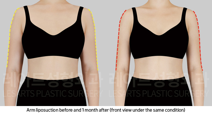 arm_liposuction_02_04_250219