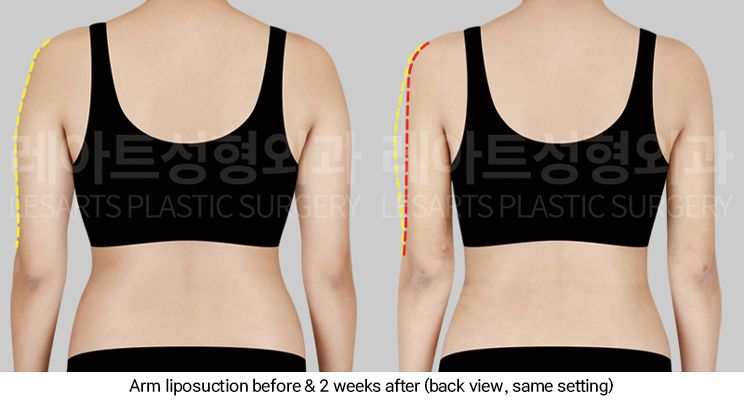 arm_liposuction_02_04_250311