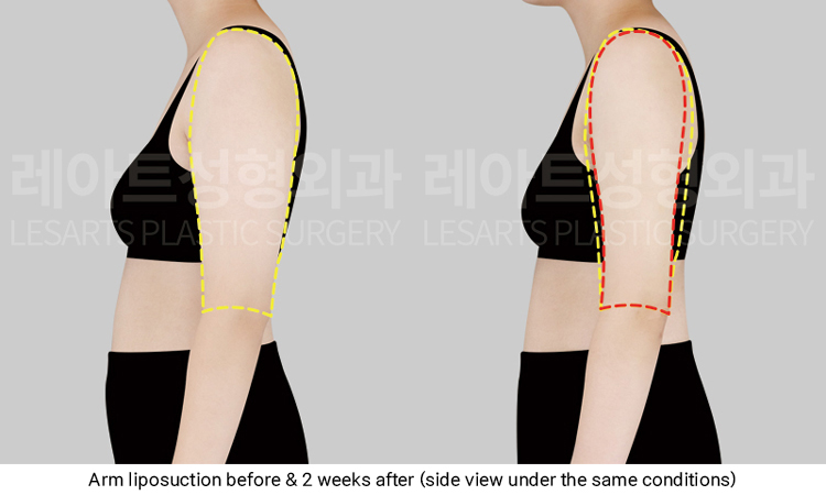 arm_liposuction_02_04_250319
