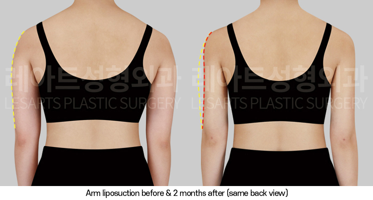 arm_liposuction_02_04_250320