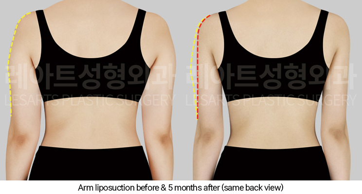 arm_liposuction_02_04_250327
