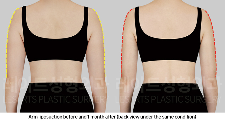 arm_liposuction_02_05_250219