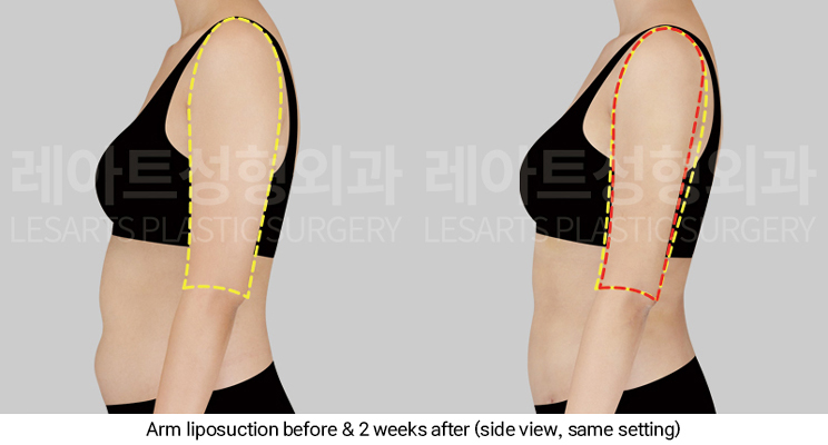 arm_liposuction_02_05_250311