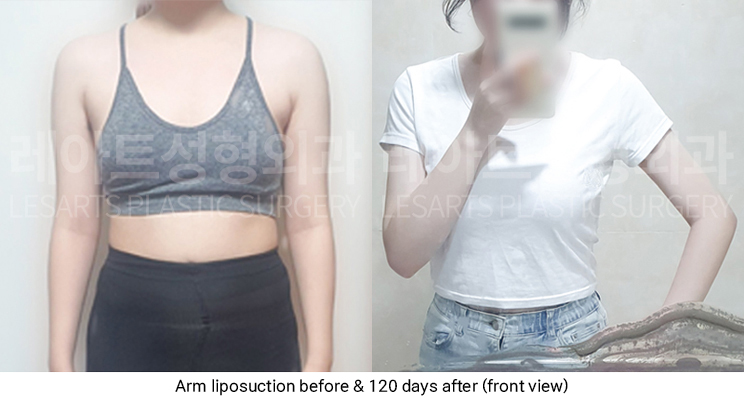arm_liposuction_02_05_250319