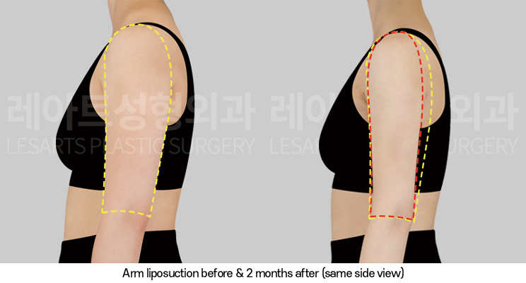 arm_liposuction_02_05_250320