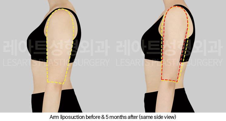 arm_liposuction_02_05_250327