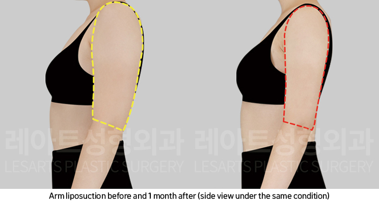arm_liposuction_02_06_250219