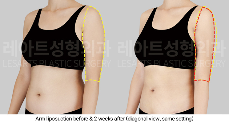 arm_liposuction_02_06_250311