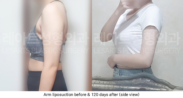 arm_liposuction_02_06_250319