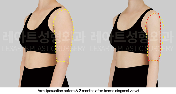 arm_liposuction_02_06_250320