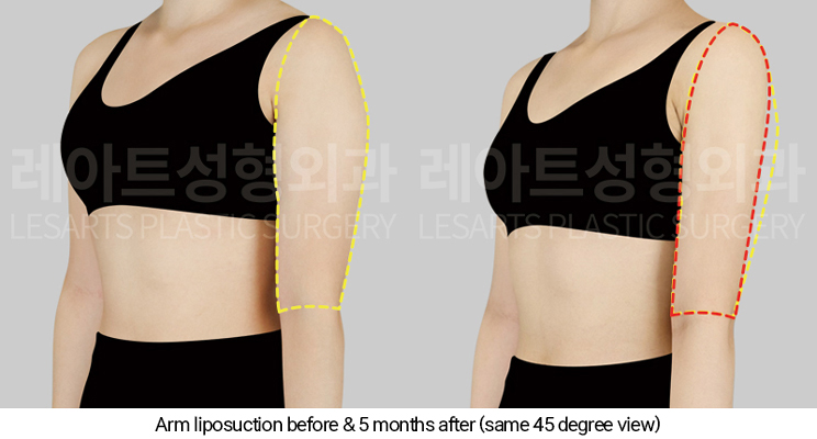 arm_liposuction_02_06_250327
