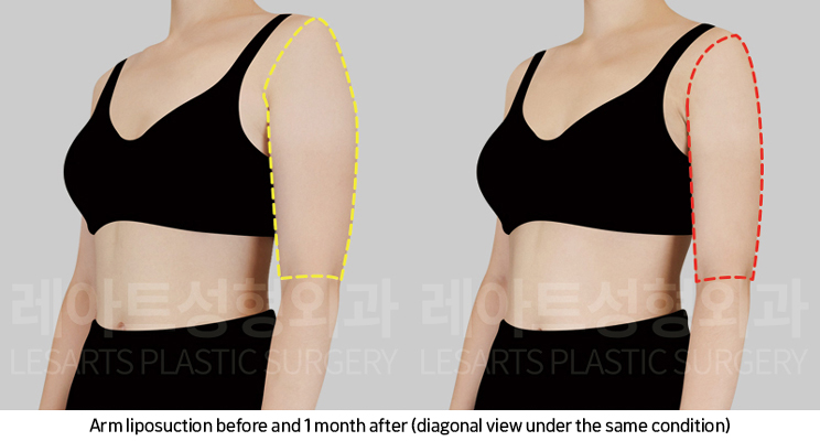 arm_liposuction_02_07_250219