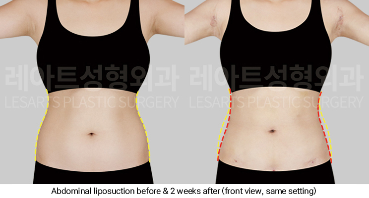 arm_liposuction_02_07_250311