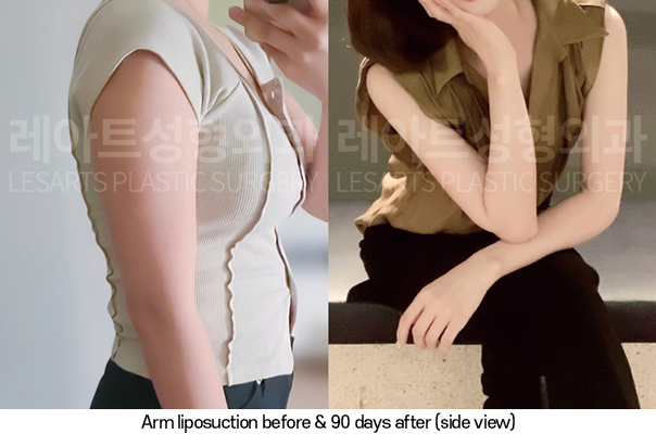 arm_liposuction_02_07_250320