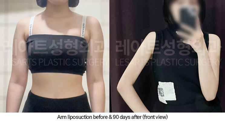 arm_liposuction_02_07_250327