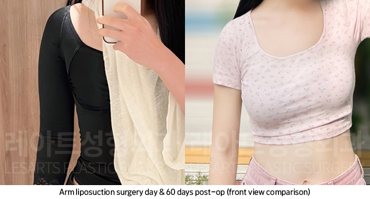arm_liposuction_02_08_250219