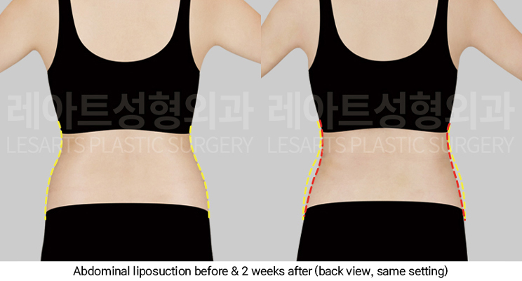 arm_liposuction_02_08_250311